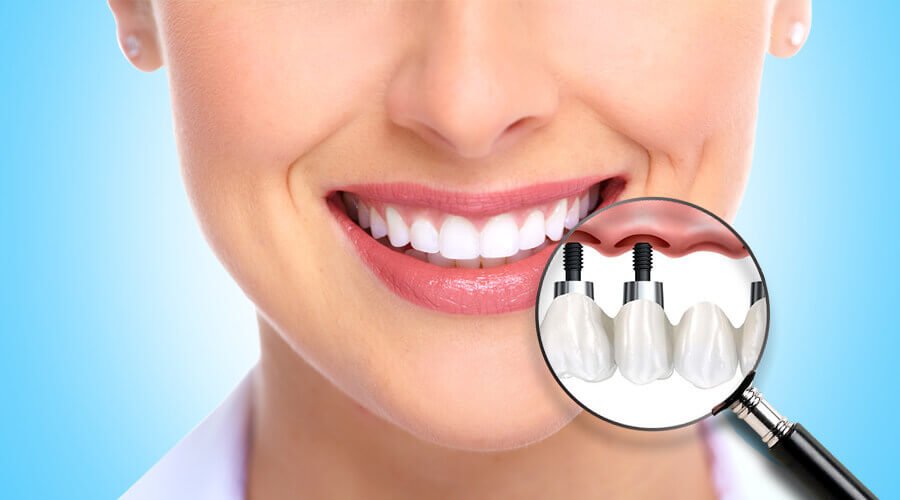 Dental İmplantlar